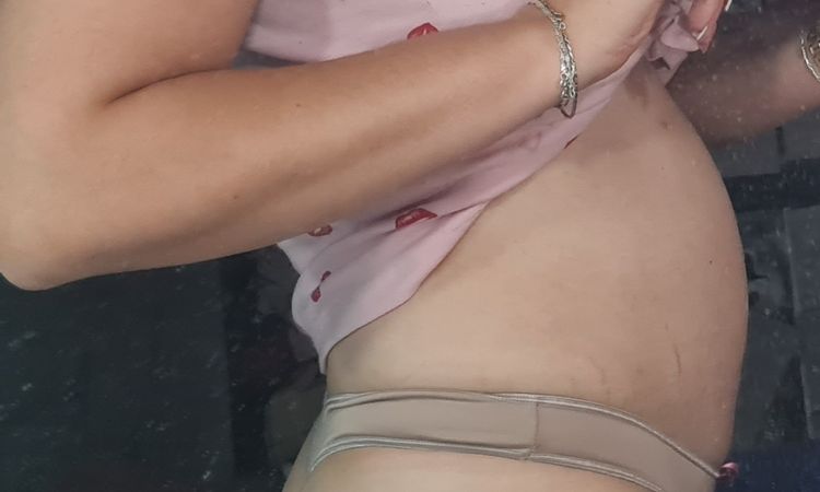 Abdomen peor que antes de abdominoplastia - 48072