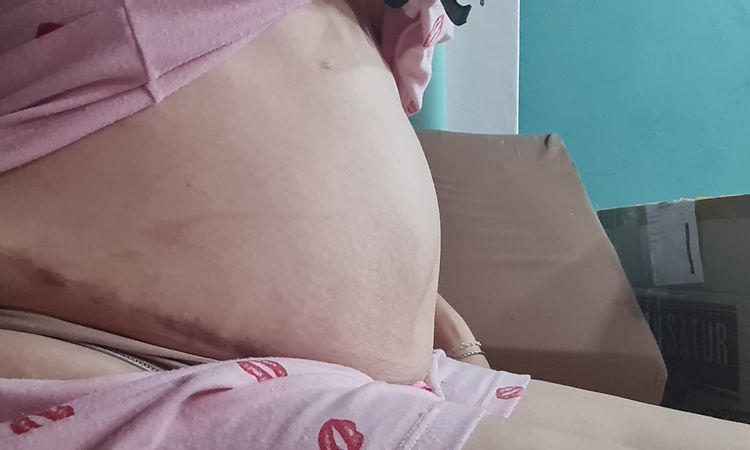 Abdomen peor que antes de abdominoplastia - 48073