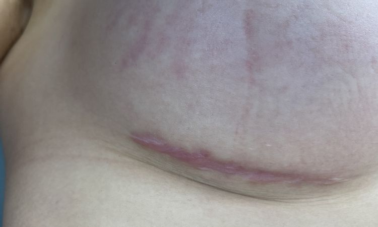 Mejorar cicatriz surco mamario post aumento de mamas - 48770