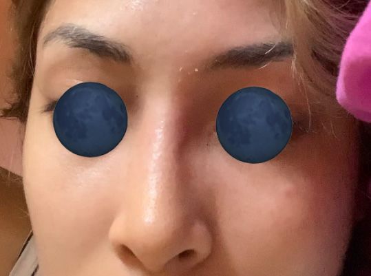 Nariz hundida post un mes rinoplastia - 49320