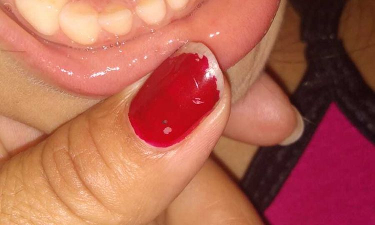 Mi nena de 6 tiene dientitos atrás de sus dientes - 49758