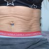 Tratamiento para flacidez abdominal sin panza