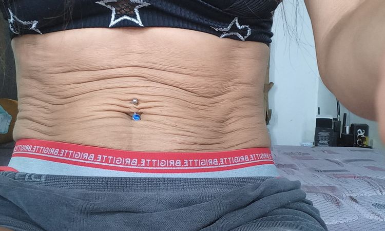 Tratamiento para flacidez abdominal sin panza - 49759