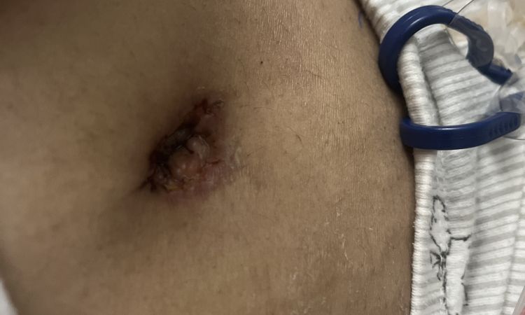 Quisiera saber si tengo una infección en el ombligo - 50127
