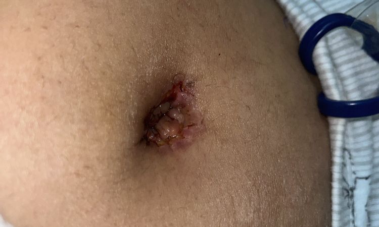 Quisiera saber si tengo una infección en el ombligo - 50128