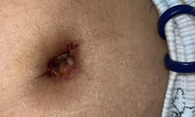 Quisiera saber si tengo una infección en el ombligo - 50129