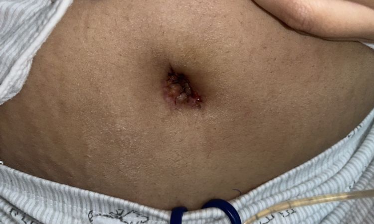 Quisiera saber si tengo una infección en el ombligo - 50130
