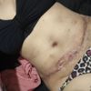 Cicatriz abdominoplastia se abre al mes de postoperatorio