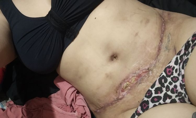 Cicatriz abdominoplastia se abre al mes de postoperatorio - 52158