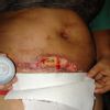 Cicatriz abdominoplastia se abre al mes de postoperatorio