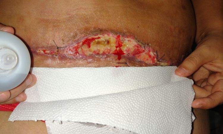 Cicatriz abdominoplastia se abre al mes de postoperatorio - 52159