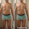 Aumento de volumen  de piernas con grasa autóloga