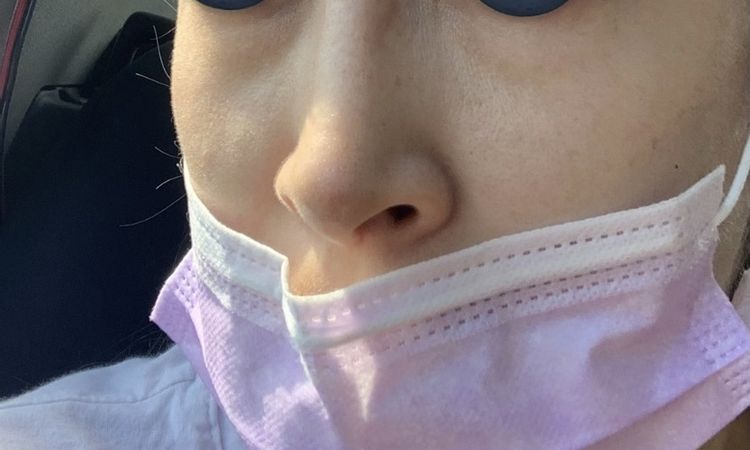 Hundimiento en costados de la nariz a los 6 meses post rinoplastia - 53351