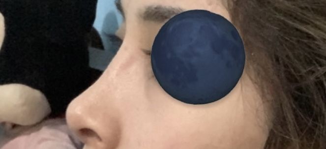 Hundimiento en costados de la nariz a los 6 meses post rinoplastia - 53353