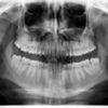 Cirugía maxilofacial de extracción cordales