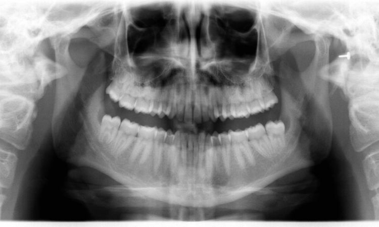 Cirugía maxilofacial de extracción cordales - 53956