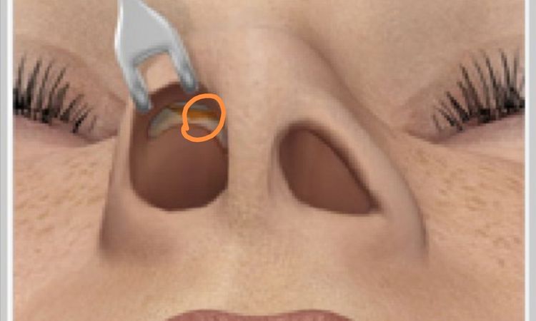 cicatriz suelta y abultada, rinoplastia - 55683