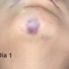 Moretones tras aplicación de Ácido Hialurónico, ¿necesito hialuronidasa?