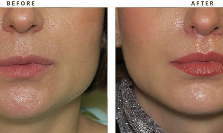 Lip Lift o Lifting de Labio en Argentina - 56178