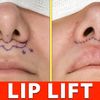 Lip Lift o Lifting de Labio en Argentina
