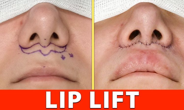 Lip Lift o Lifting de Labio en Argentina - 56179