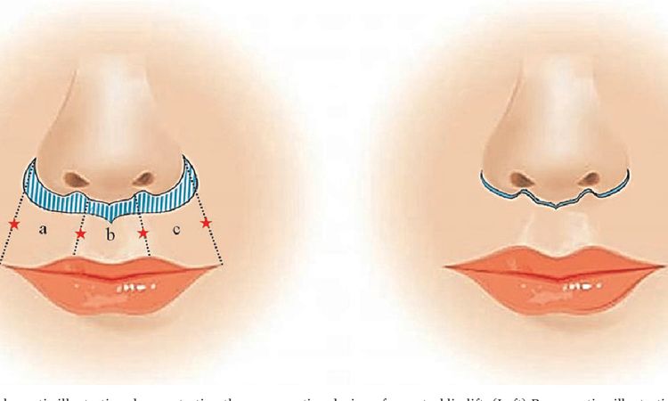 Lip Lift o Lifting de Labio en Argentina - 56180