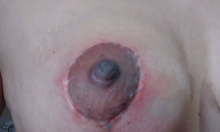 Descartar infección en areolas tras mastopexia - 57509