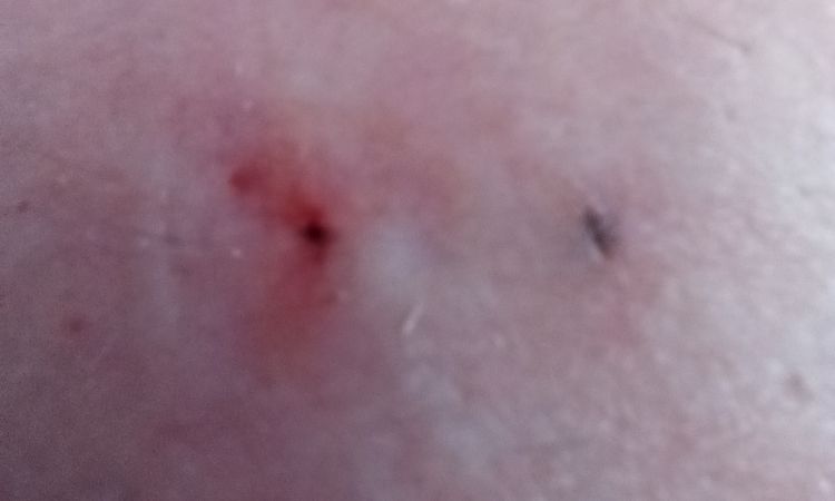 Tengo 2 puntos como pelos encarnados desde mi aumento de mamas - 57828