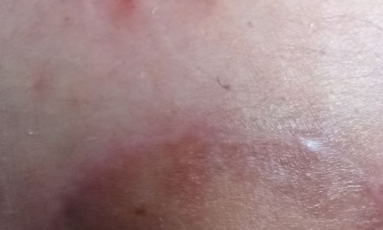 Tengo 2 puntos como pelos encarnados desde mi aumento de mamas - 57829