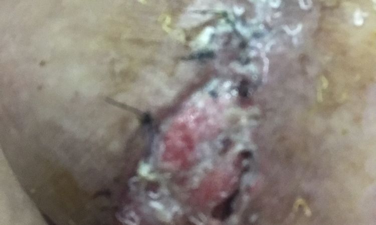 Puntos abiertos tras mastopexia con implantes, ¿se puede suturar de nuevo? - 58262