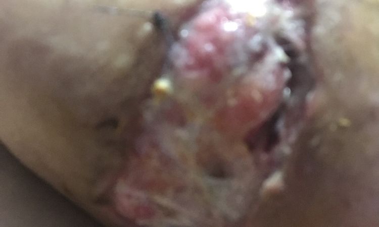 Puntos abiertos tras mastopexia con implantes, ¿se puede suturar de nuevo? - 58263