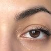 Corregir asimetría en ojos y párpados inflamados