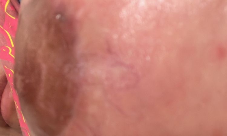 Mastopexia con aumento de senos dermatitis - 59111