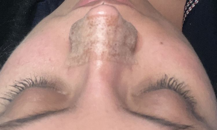 Hundimiento en el tabiqué después de la rinoplastia - 59503