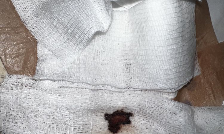 Se me abrió la herida ? O es solo sangre - 60110