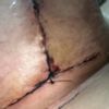 Se me abrió la herida ? O es solo sangre