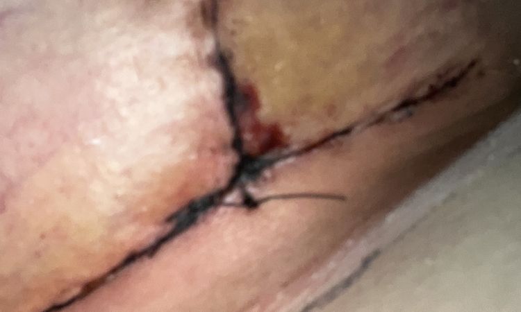Se me abrió la herida ? O es solo sangre - 60111