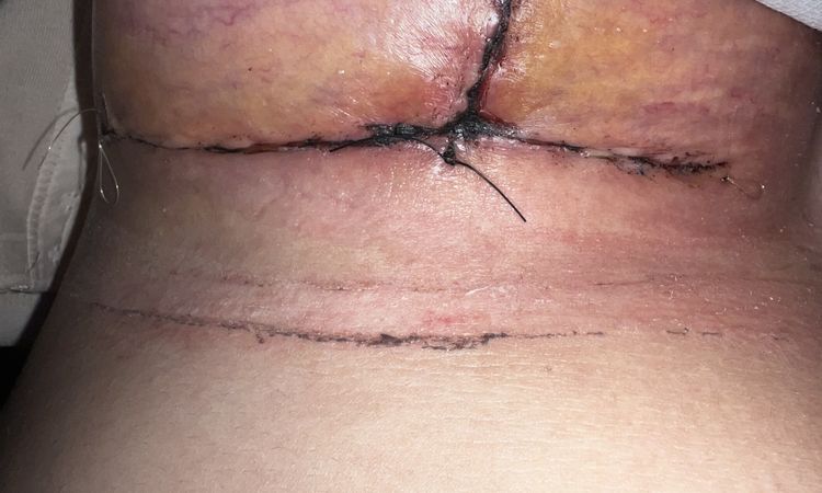 Se me abrió la herida ? O es solo sangre - 60112