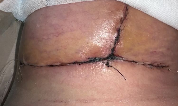 Se me abrió la herida ? O es solo sangre - 60113