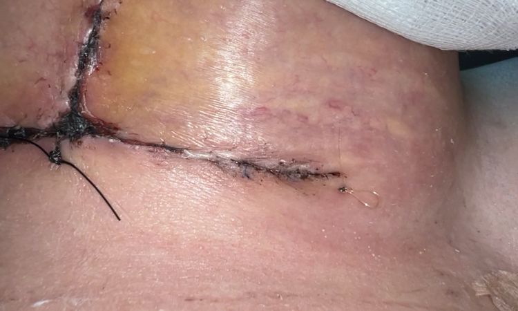 Se me abrió la herida ? O es solo sangre - 60114