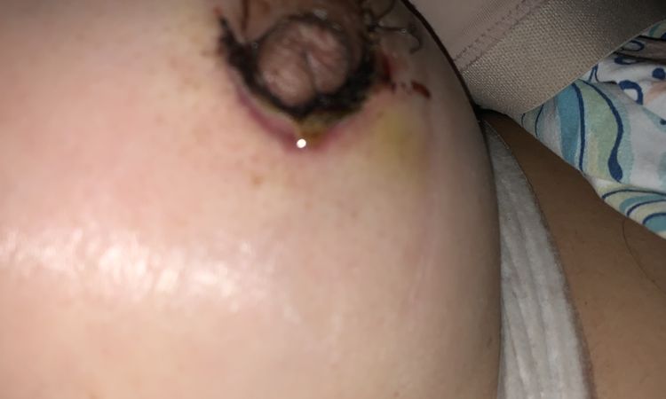 Supura pus al costado de los puntos! - 60144