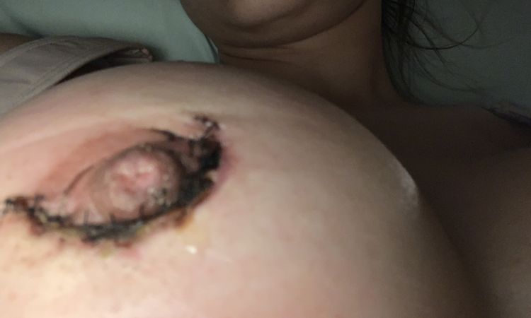 Supura pus al costado de los puntos! - 60145