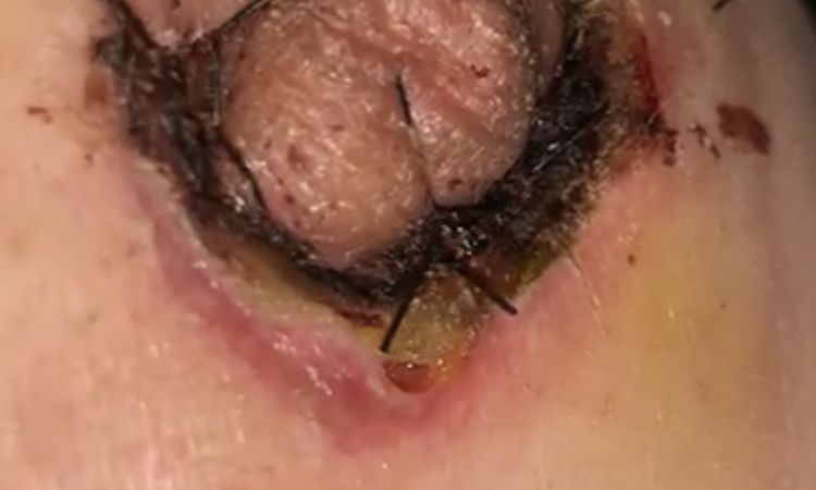 Supura pus al costado de los puntos! - 60147