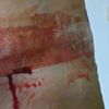 Herida sangrando tras abdominoplastia
