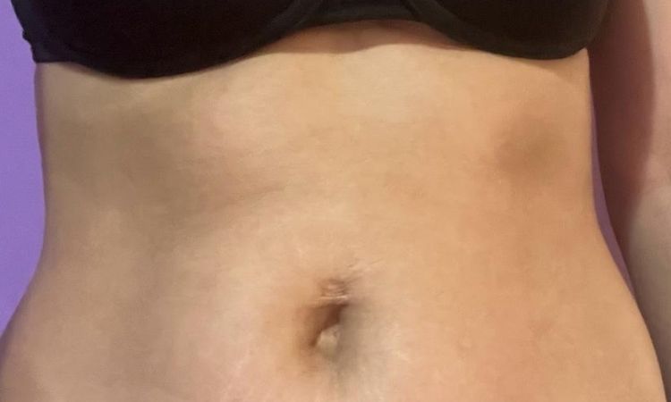 ¿Hay alguna cirugía de abdomen para mejorarlo? - 61548