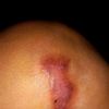 Eliminar cicatriz queloide en rodilla