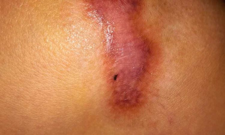 Eliminar cicatriz queloide en rodilla - 63468
