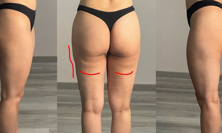 Piernas: Liposucción? Lipoescultura? Tratamientos no invasivos? - 64412