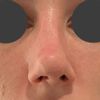 Rinomodelación en nariz operada 3 veces, torcida y con injerto visible - 65363