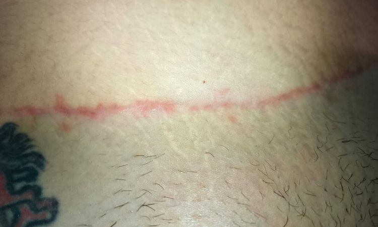 Expectativas de cicatrización posiblemente queloide - 65732